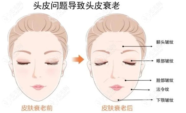 深圳鹏程植发的不剃发长发种植现在享六折优惠！