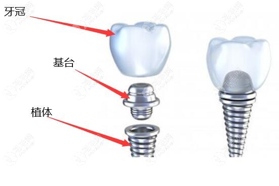 种植牙的植体材质分几种类型?除了纯钛和钛锆合金还有...