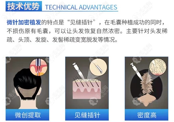 合肥大麦微针PPT微针加密技术植发怎么样？技术优势