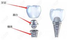 种植牙的植体材质分几种类型?除了纯钛和钛锆合金还有...