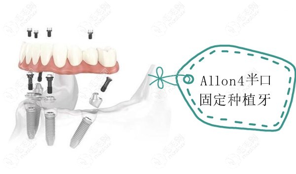 Allon4全固定种植牙