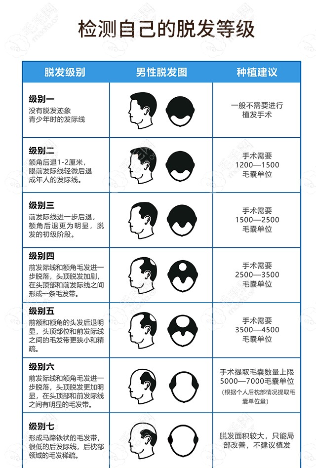 脱发等级表