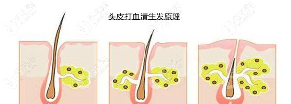 头皮打血清生发原理