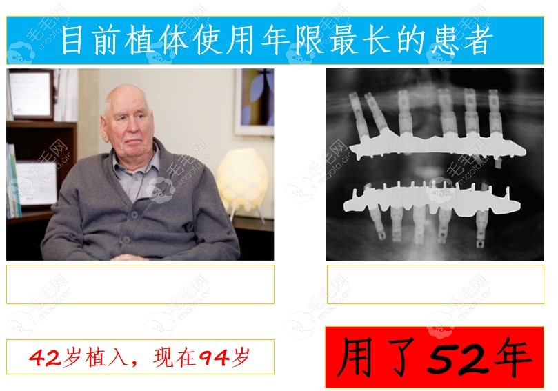 瑞典种植牙品牌排行及价格表,榜内植体无副作用且终身质保