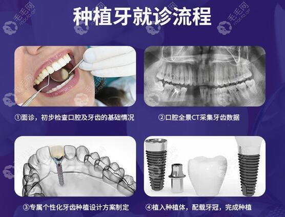 种植义齿的流程步骤