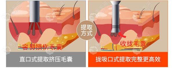 新生3D植发手术过程——毛囊提取