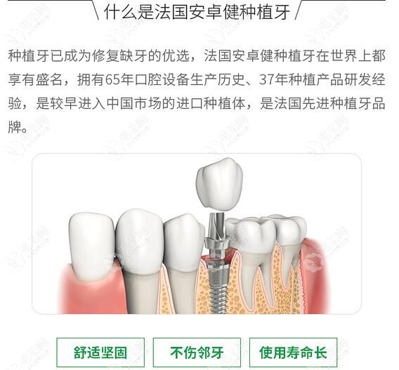 法国安卓健种植牙优势