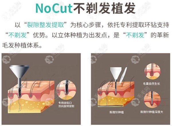 NoCut不剃发植发