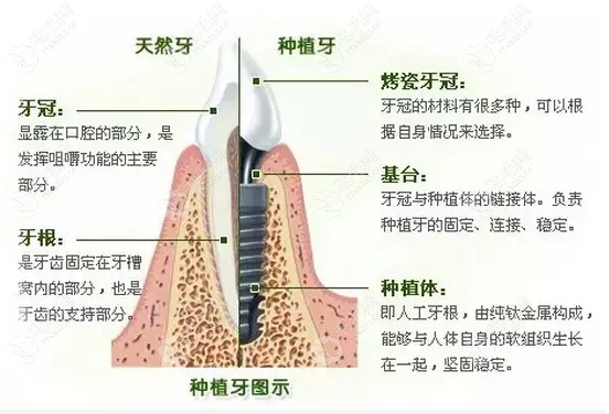 德国贝格种植牙成功率更高