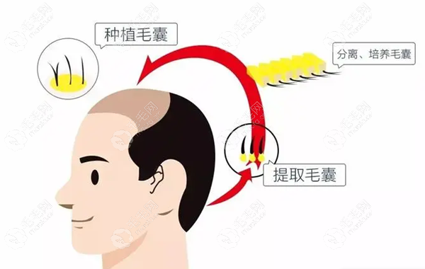 微针移植毛囊单位详细过程