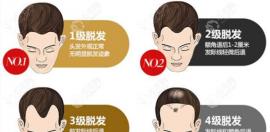 问M字头植发多少钱之前先来了解下植发1毛囊单位的价格吧!