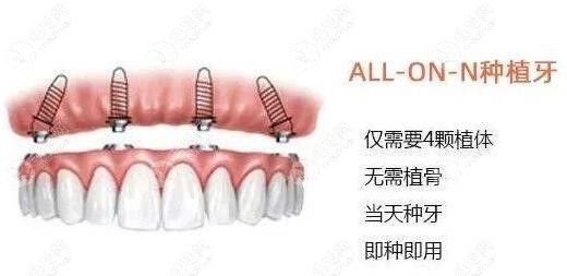 allon4全固定种植牙