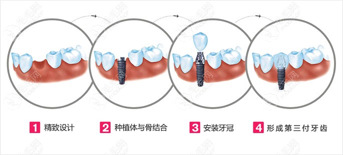 全口种植牙齿的价格一般多少钱