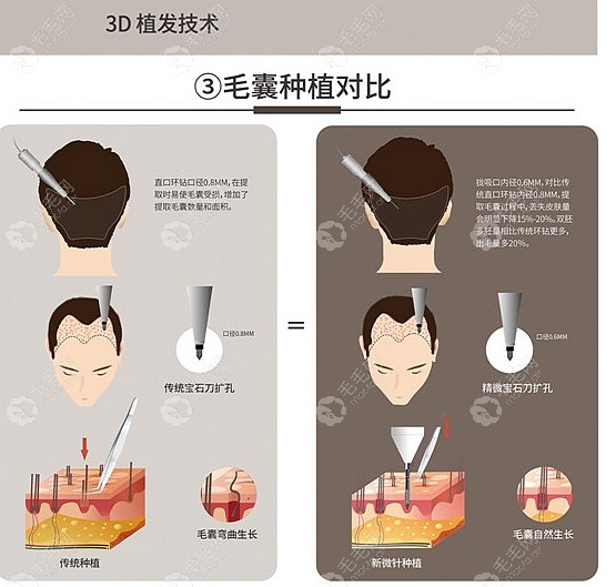 新生3d植发费用不乱收费