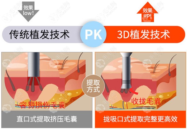 新生植发技术优势