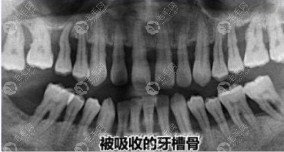 被吸收的牙槽骨图片