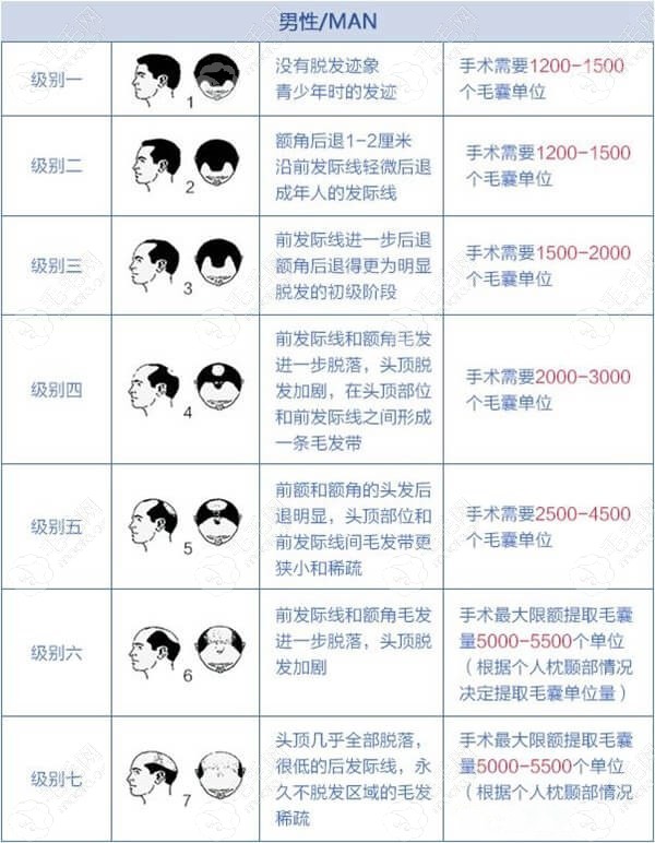 男士脱发等级种植毛囊图