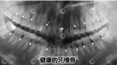 健康的牙槽骨ct