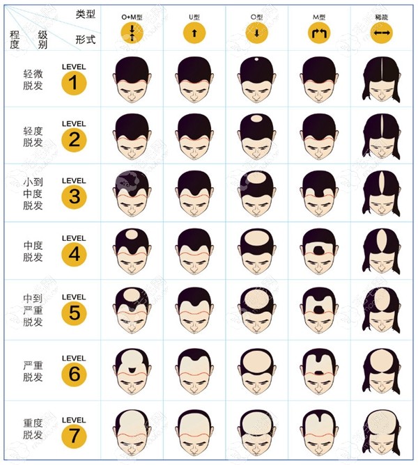 六级脱发植发需要多少毛囊单位?植4000/5000个毛囊是几级脱发