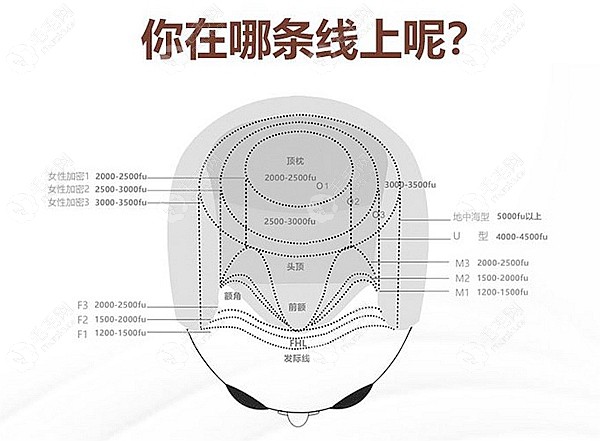 查看下自己的脱发程度大约需要种多少单位