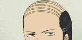 男性头顶头发稀疏是适合植发还是加密，两者有什么区别吗