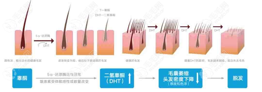 脂溢性脱发原因图