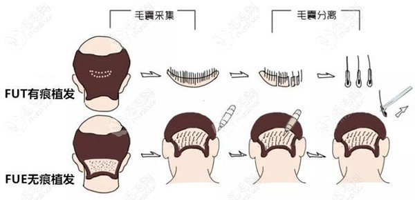 了解过什么情况下不能植发后,我发现七级脱发还能植发只是