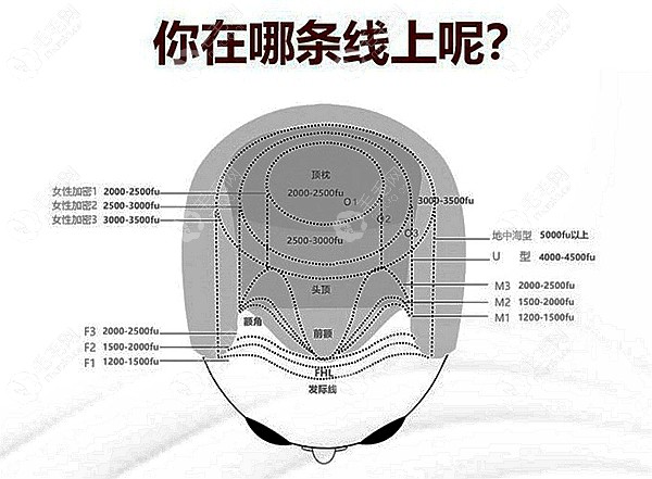 来看看你的脱发程度在哪条线上