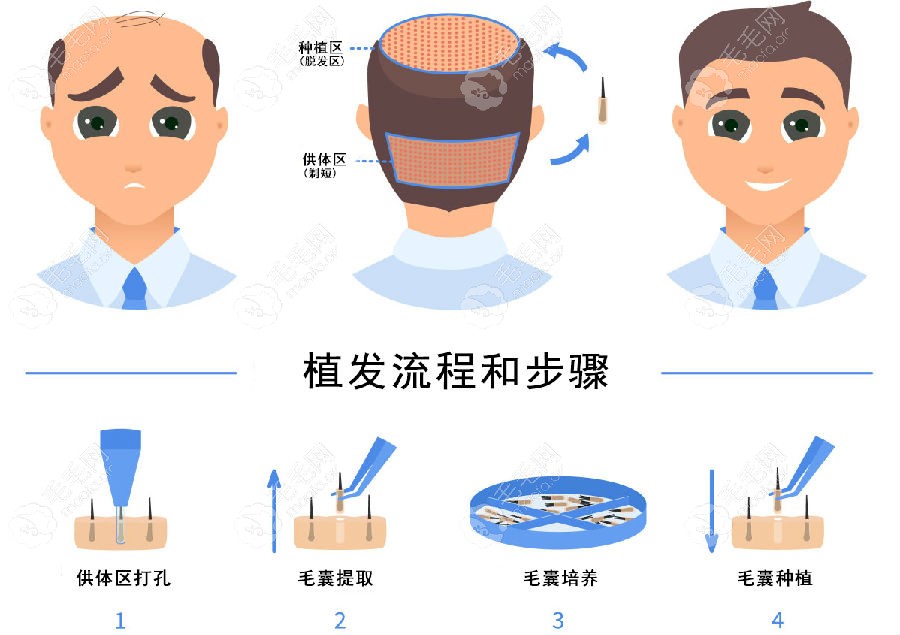 植发流程和步骤图