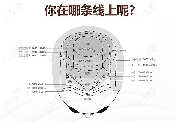 O型地中海秃顶植发