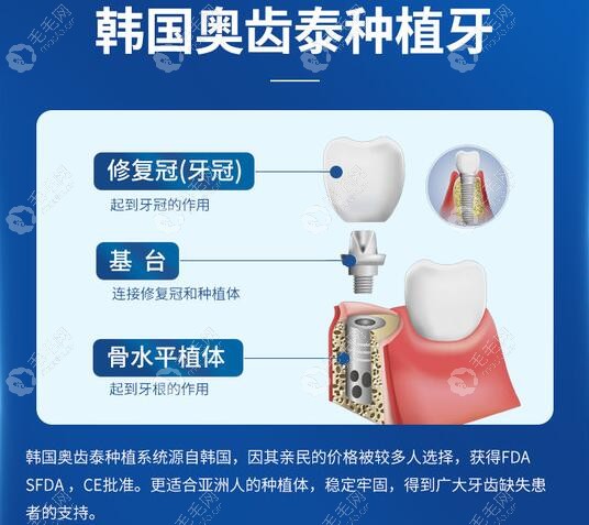 韩国奥齿泰ts和ms种植体型号的区别