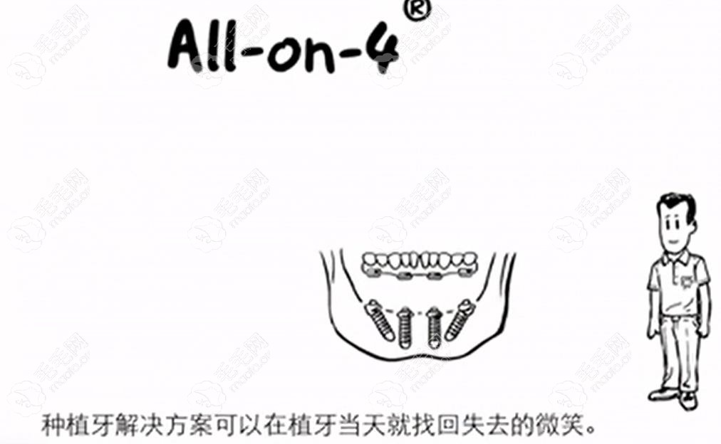 allon4种植牙演示图