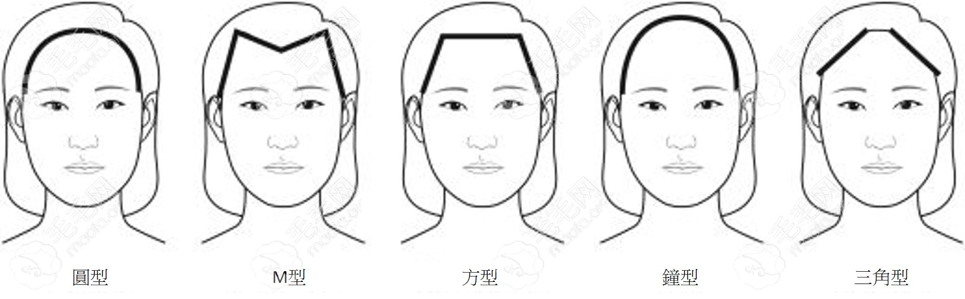 发际线类型