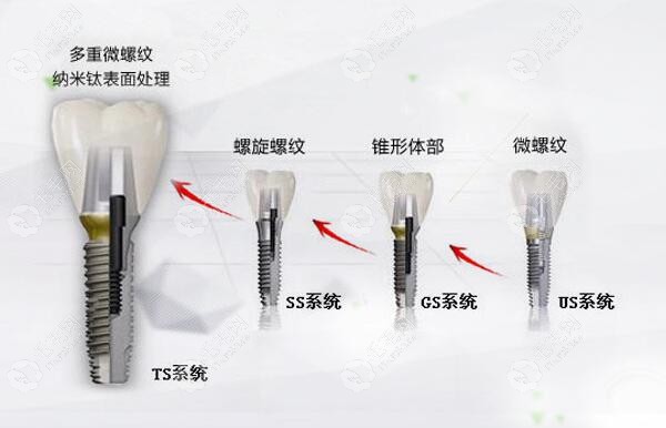 韩国奥齿泰种植体TS型号