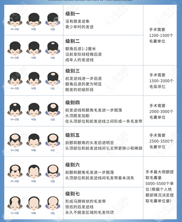 男士种植毛囊单位分级图