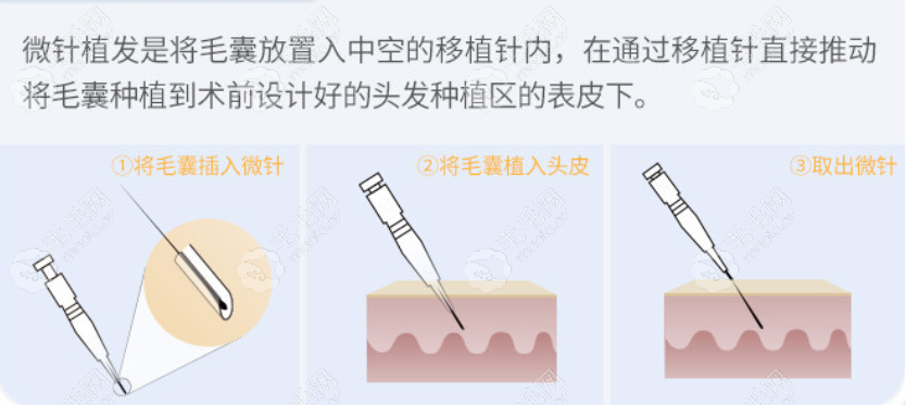 大麦微针植发过程步骤