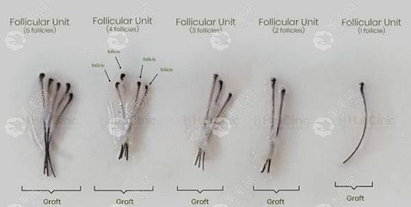 一个毛囊单位可以长几根头发