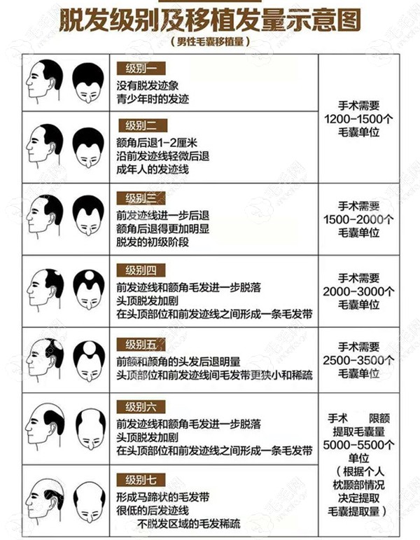 恩施小面积植发价格费用