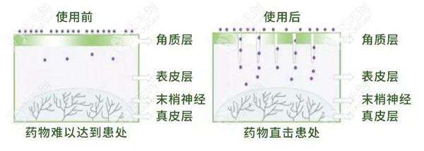 微轮滚针治疗脱发原理图