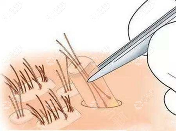 身体任何部位植发都需要在后枕部提取毛囊
