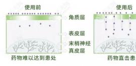 微针轮滚治疗脱发有作用,那做头皮微针生发多少钱一次呢