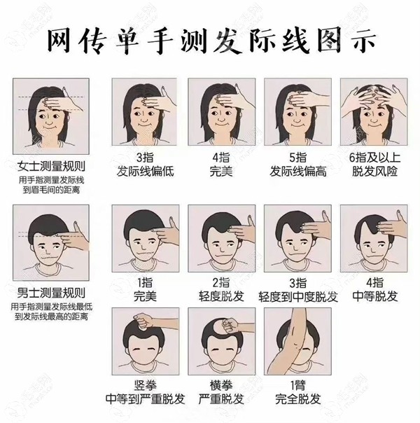 发际线后移测量图