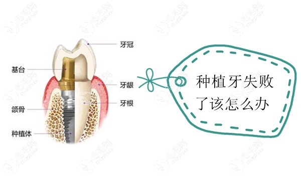 种植牙如果失败了该怎么处理