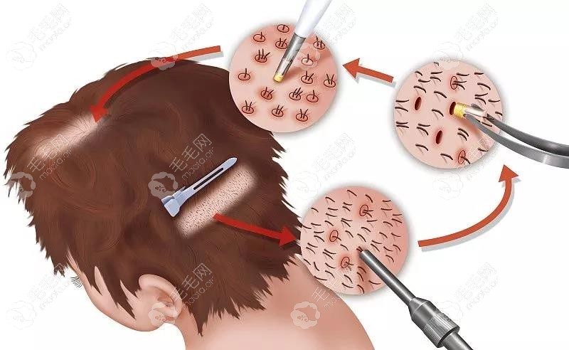植发手术的过程