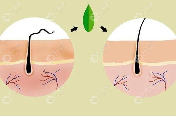 补救及控制发缝脱发方法之药物治疗