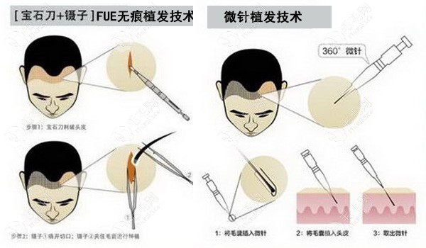 FUE植发技术和微针植发哪个好