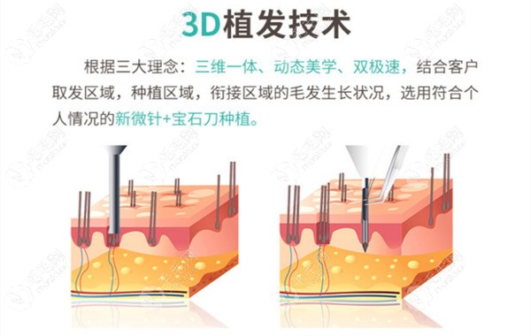 福建漳州新生3D植发技术