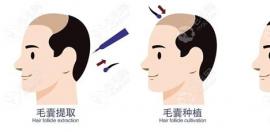 自身毛囊资源不够也能植发,可以把胡子的毛囊移植到头上
