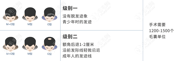 三级u型脱发需要植发多少单位,那u型头发稀的5级脱发植多少