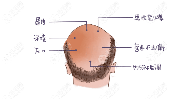 大面积脱发的促成条件